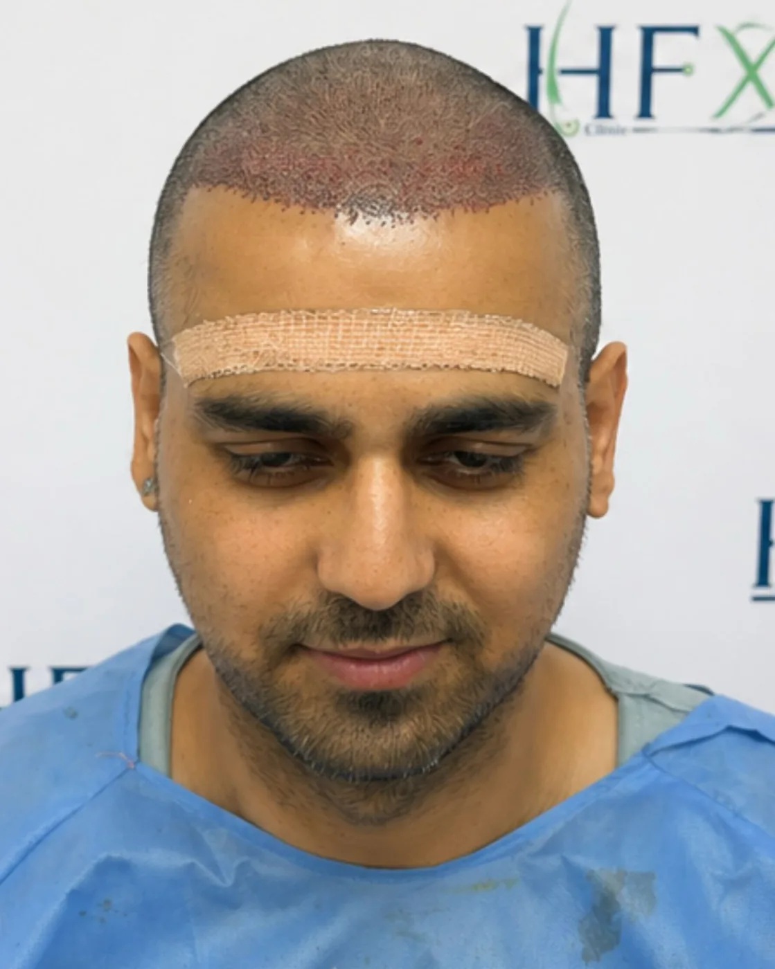 After treatment - Nitish