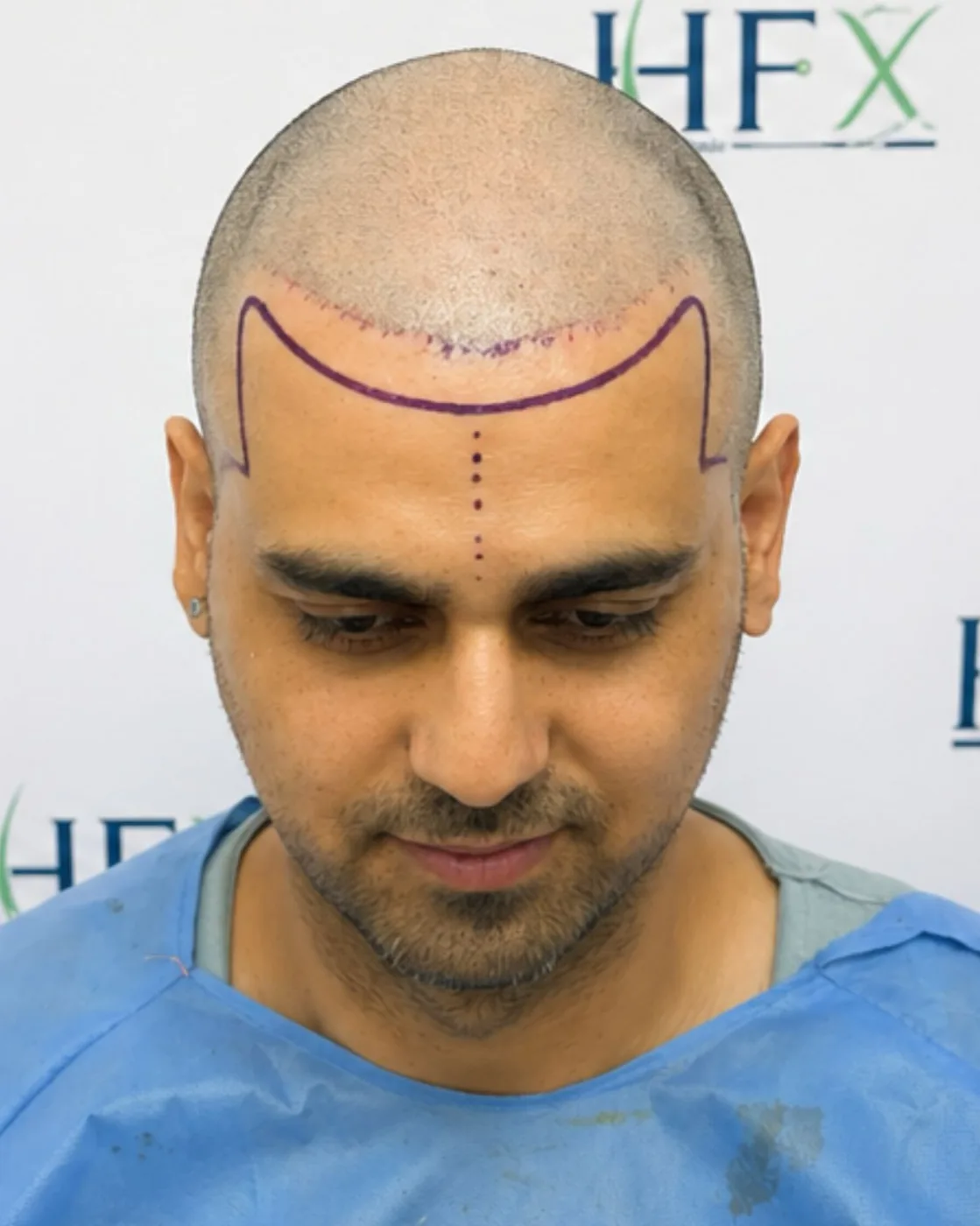 During treatment - Nitish