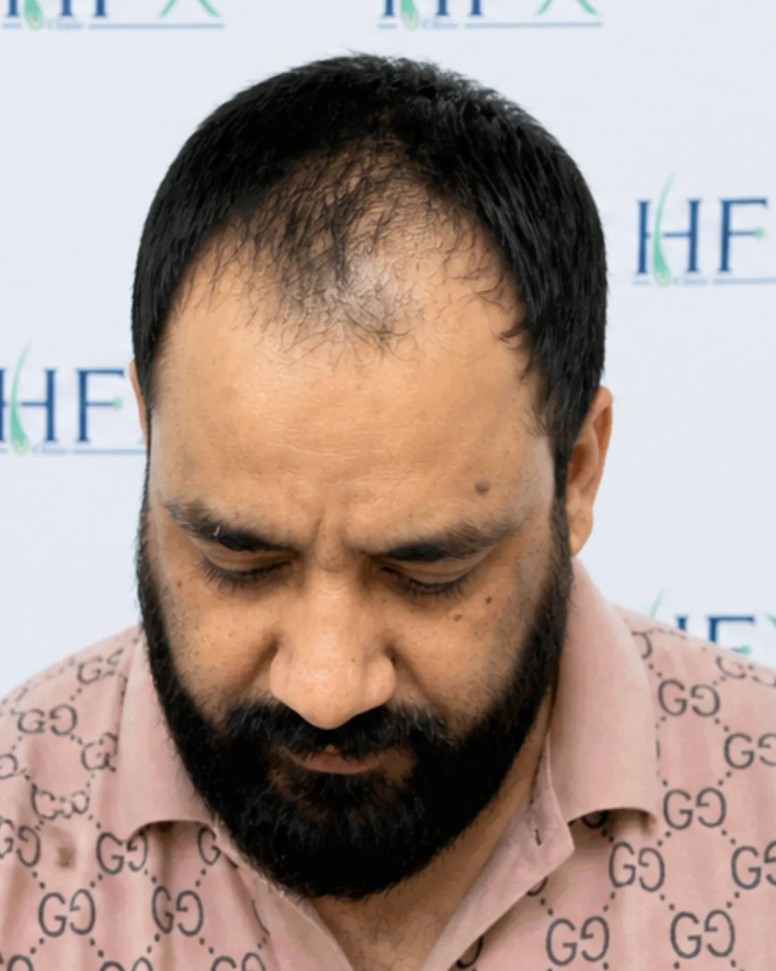 Before treatment - Abdullah