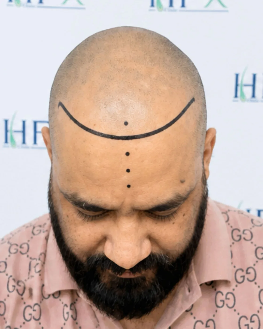 During treatment - Abdullah
