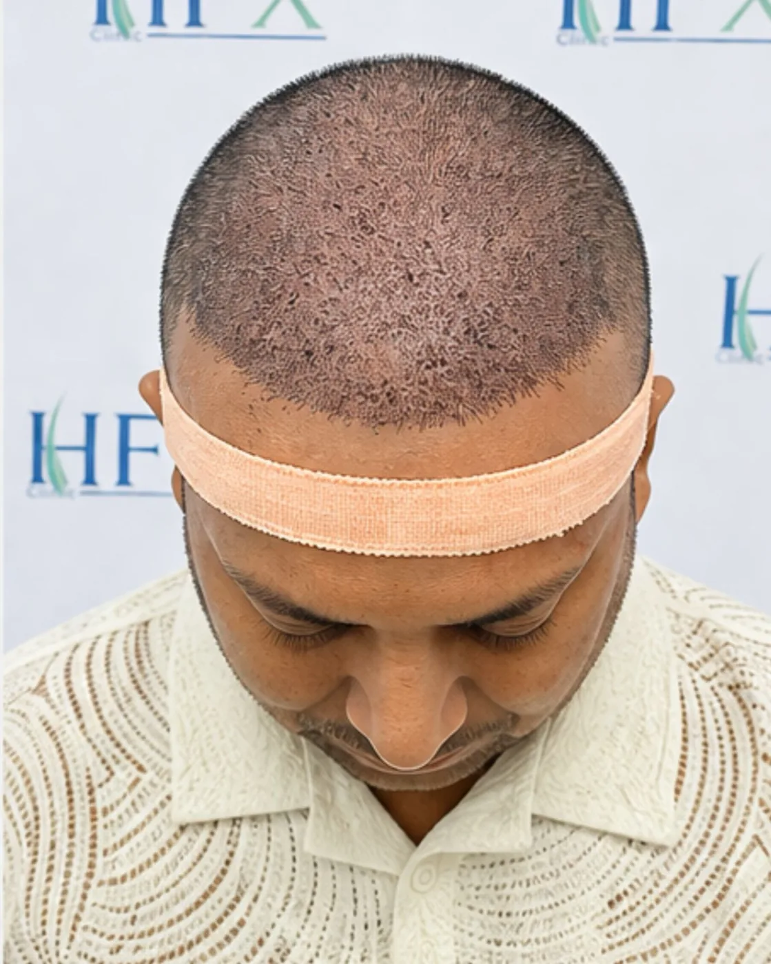 After treatment - Jeetu Gupta
