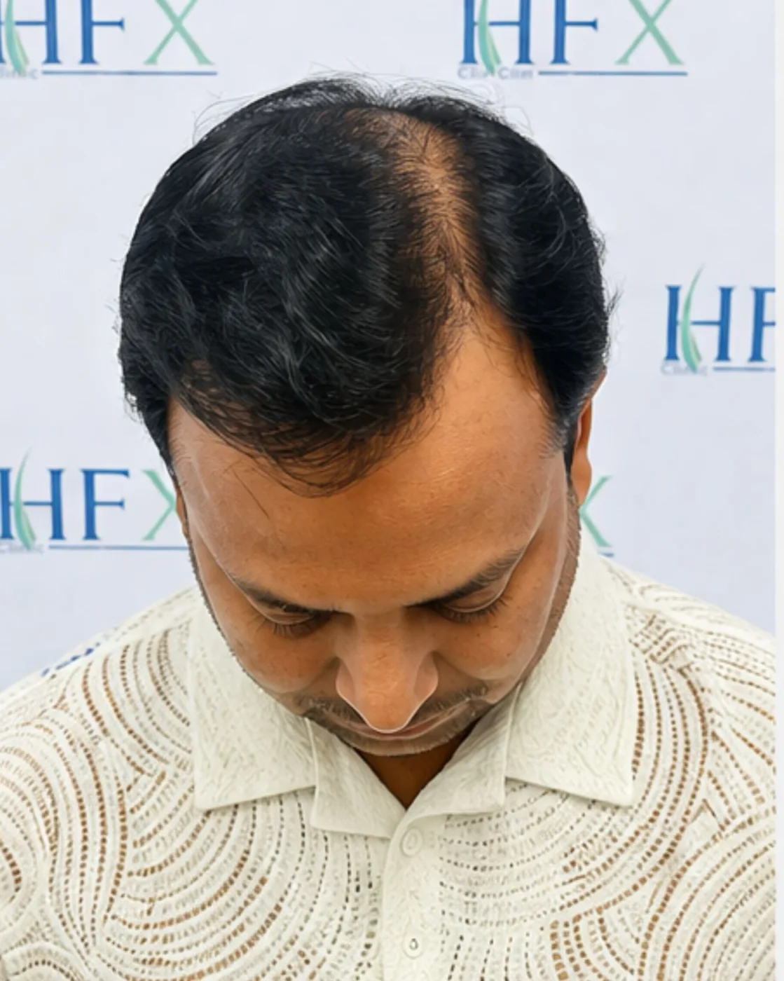 Before treatment - Jeetu Gupta
